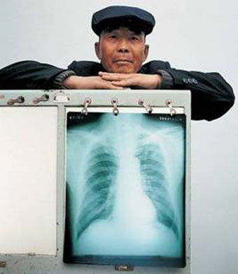 Man having standing behind an x-ray picture